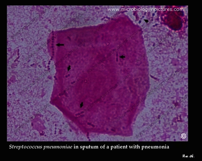 chains of pneumococci in sputum